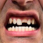 How to Handle a Knocked-Out Tooth