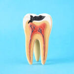 Early Signs of Tooth Decay You Should Never Ignore